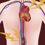 Abdominal Aortic Aneurysm and Thoracic Aortic Aneurysm, human anatomical chart